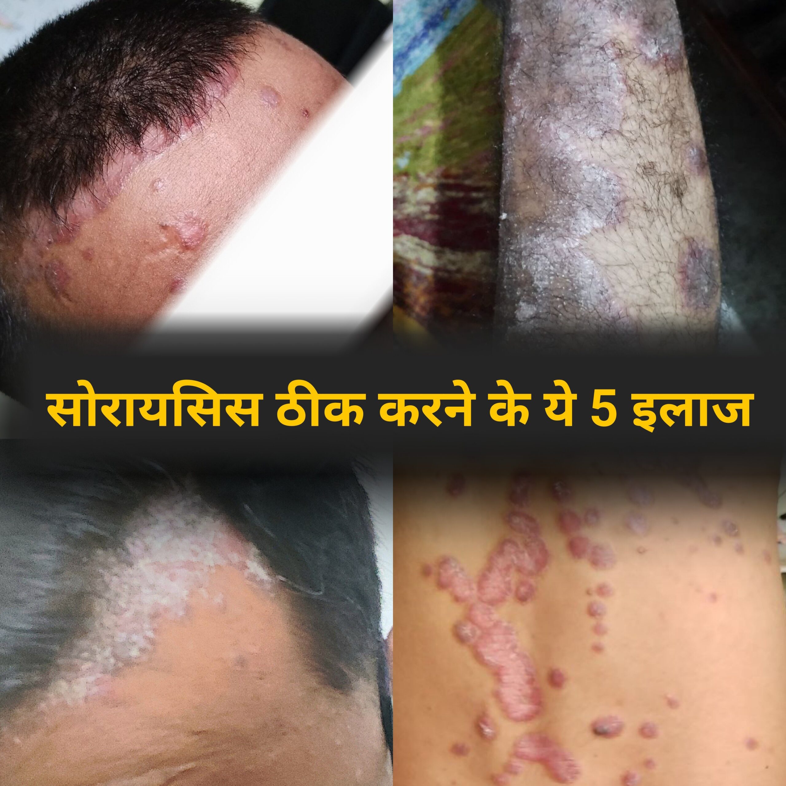 सोरायसिस Psoriasis